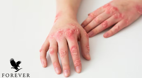 بیماری لوپوس پوستی